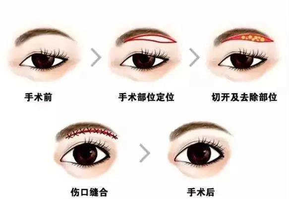 4,缝合切眉术后的刀口