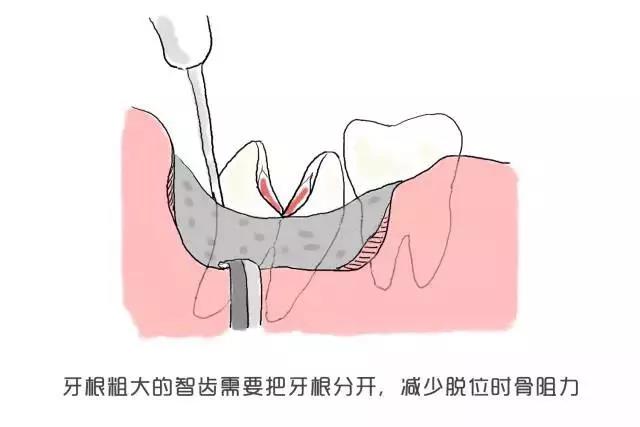 拔智齿全过程图片