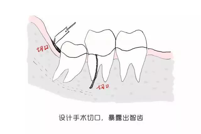 拔智齿全过程图片