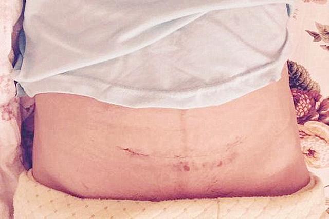 原创女人的子宫扛不住多次剖腹产为了自己的身体不要超过这个次数