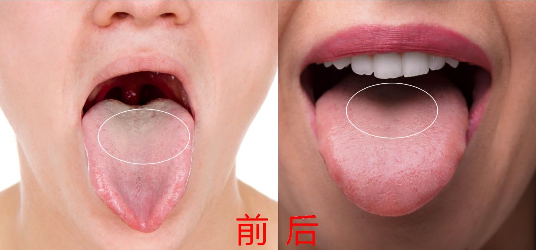 口臭九成是脾胃失调泡它当茶喝消除口臭清湿热
