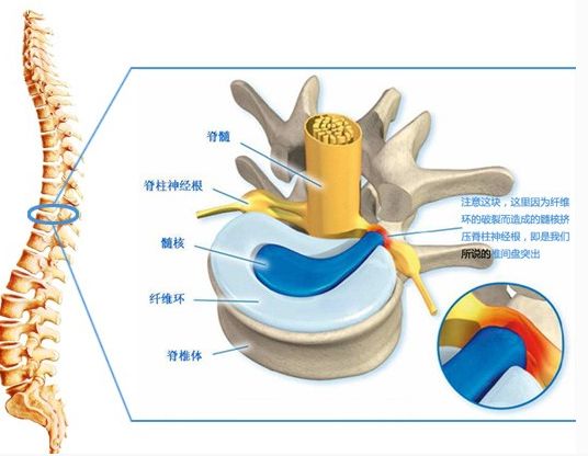 腰椎间盘突出内镜微创手术患者招募 费用大幅减免 治疗