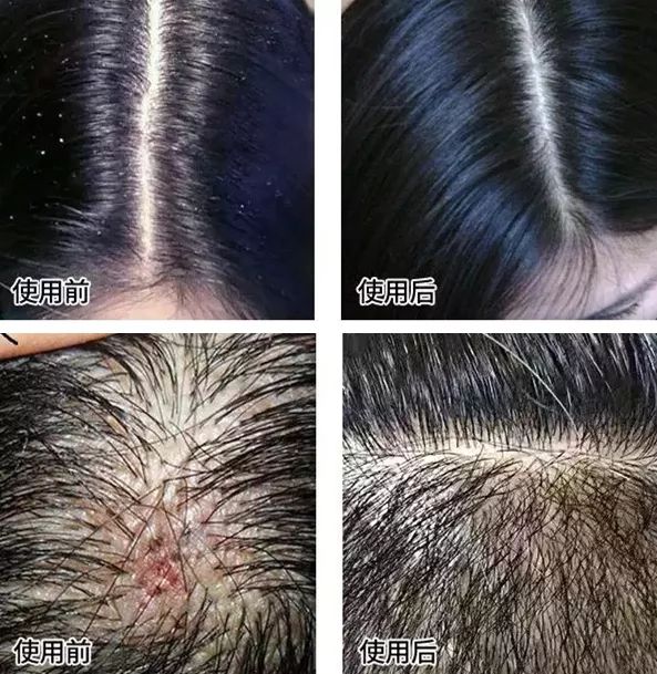 感觉头皮身上有虫爬头发越掉越少千万要小心了