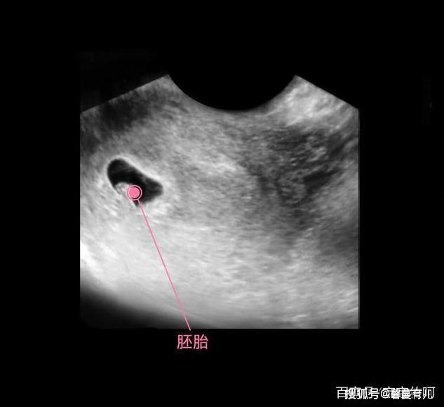 孕13周女宝生殖图图片