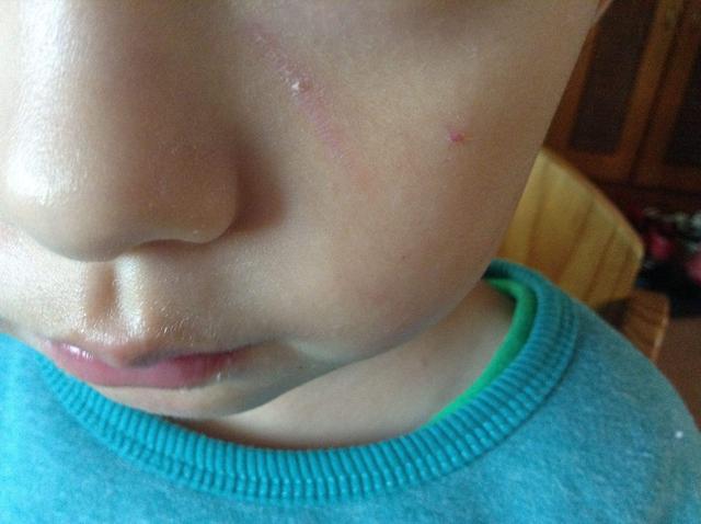 面部疤痕修复是多种治疗疤痕的方式相结合,针对不同年龄,不同肤质,不