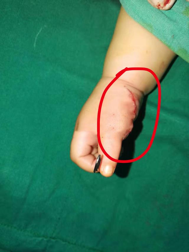 桡侧多指(例如分叉拇指),常见于白种人及亚洲人,发病率为新生儿的1
