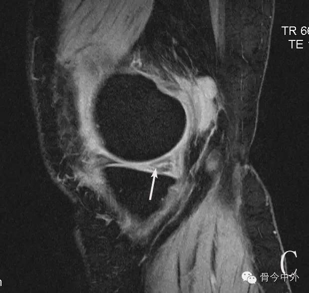 三分鐘教會你半月板損傷的mri表現