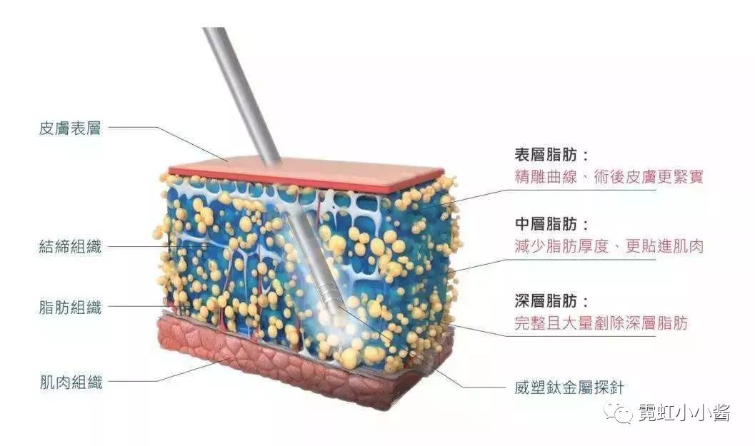 腹肌雕刻手术图片