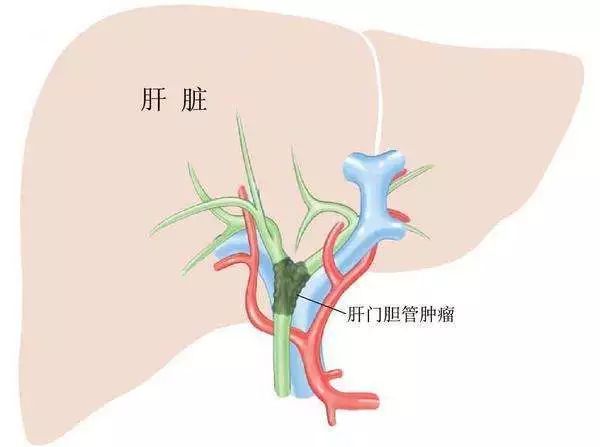 它被称为癌王之王专家告诉你这些秘密