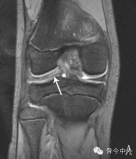 三分鐘教會你半月板損傷的mri表現