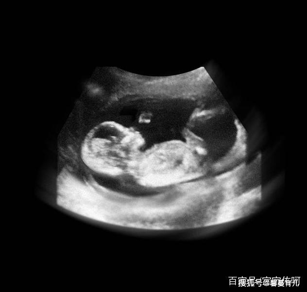 胎儿从卵泡到性别形成17张图片清晰诠释男宝女宝看得很清楚