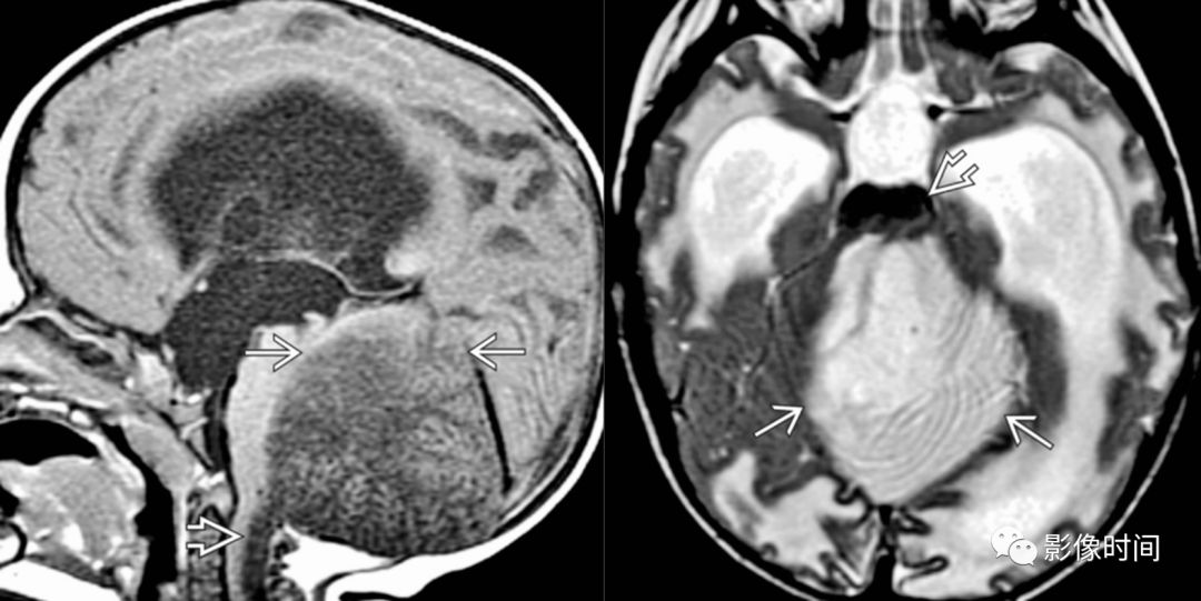 上行小脑幕切迹疝小脑半球占位导致上行小脑幕切迹疝,小脑半球跨越