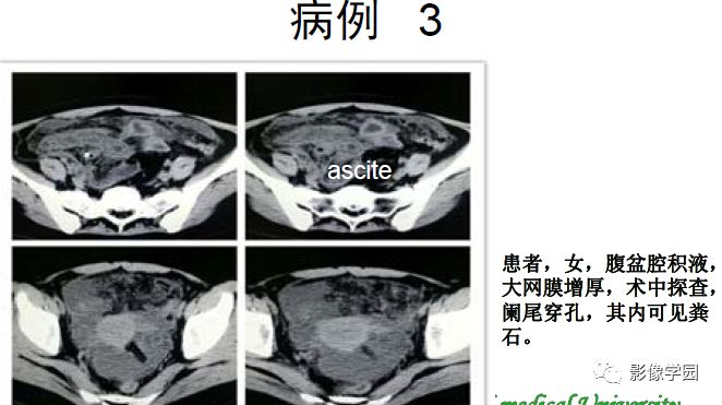 腹腔积液ct图片