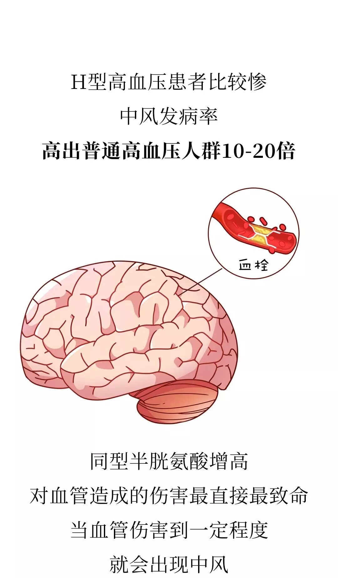 h型高血压害心又害脑光吃降压药可不行还要同时补叶酸