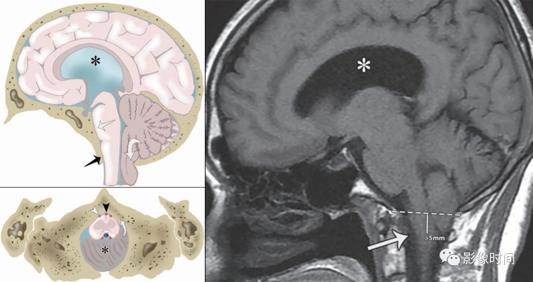 脑疝的分类及影像学特点图解