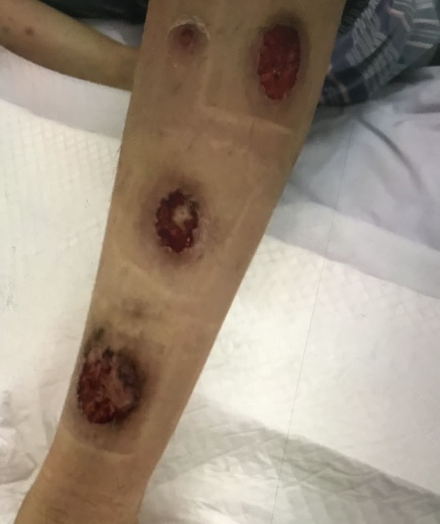 一例溃疡性结肠炎合并早孕并发坏疽性脓皮病的诊治体会