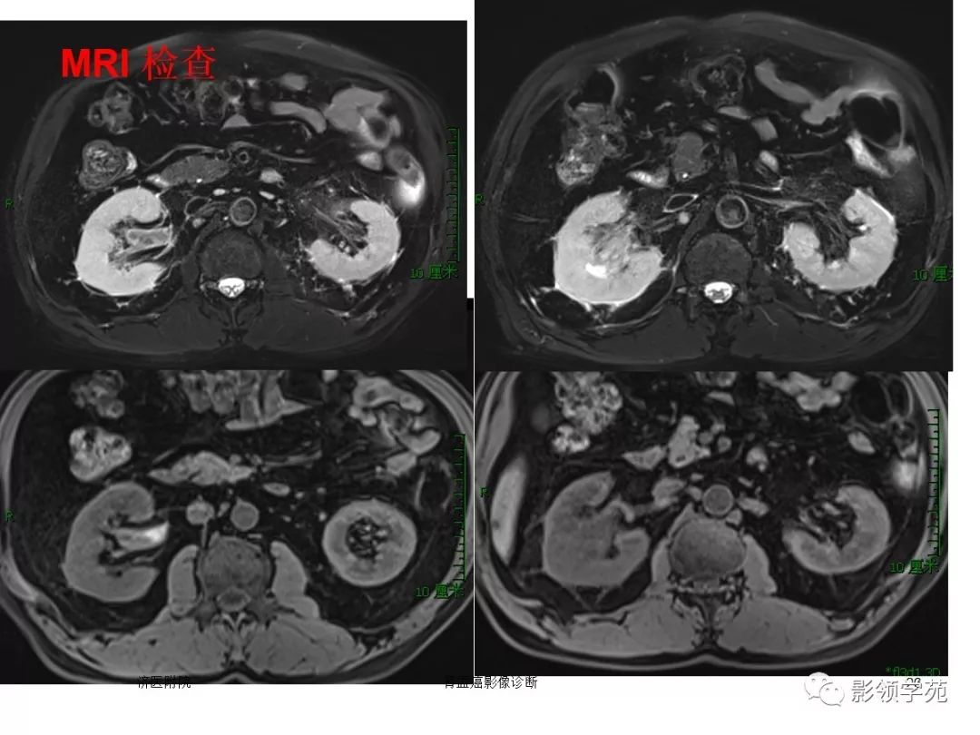 肾盂癌图片图片