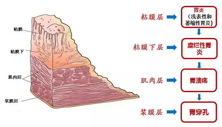 胃粘膜层分层解剖图图片