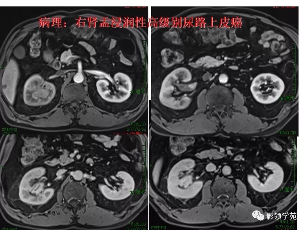 肾盂癌图片图片