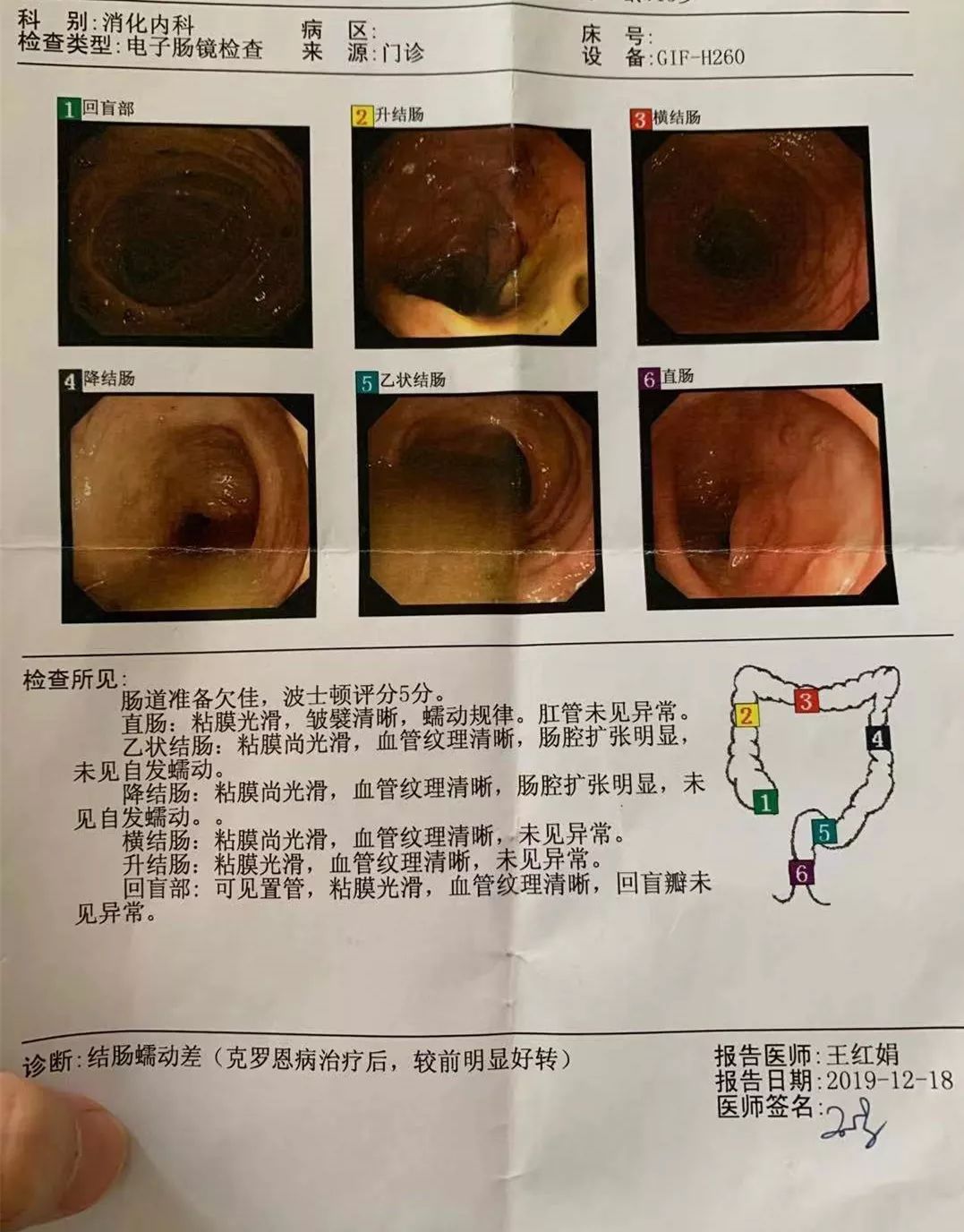 克罗恩病纵行溃疡图片图片