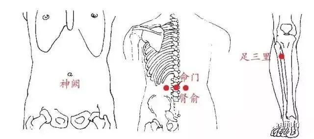 艾灸取穴:腎俞穴,命門穴,神闕穴,足三里穴