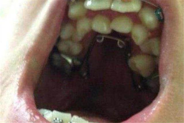 原创10岁男孩长出"双排牙",父母还自豪是营养好,网友:送医院吧