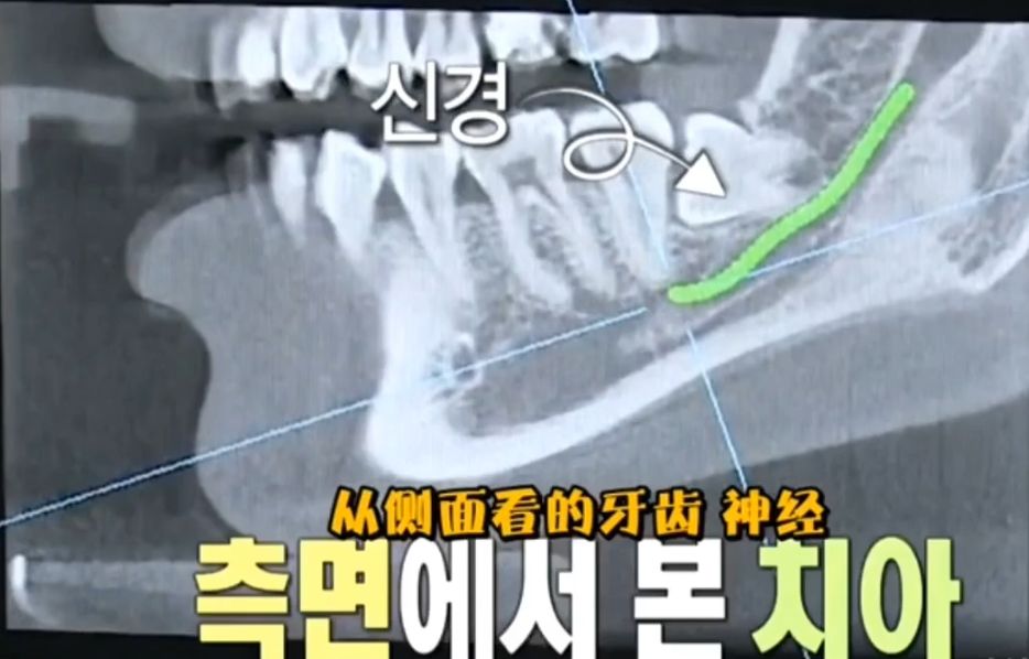 拔智齿全过程图片