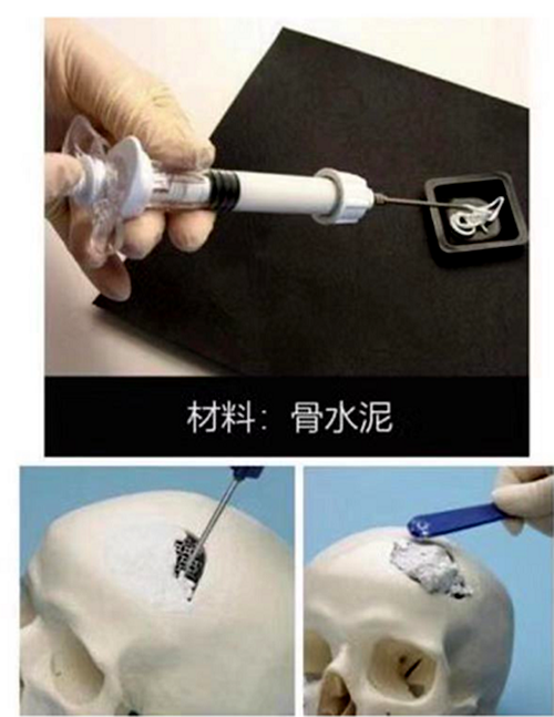 自体脂肪和骨水泥填充的区别在哪里头部整形用那个比较好