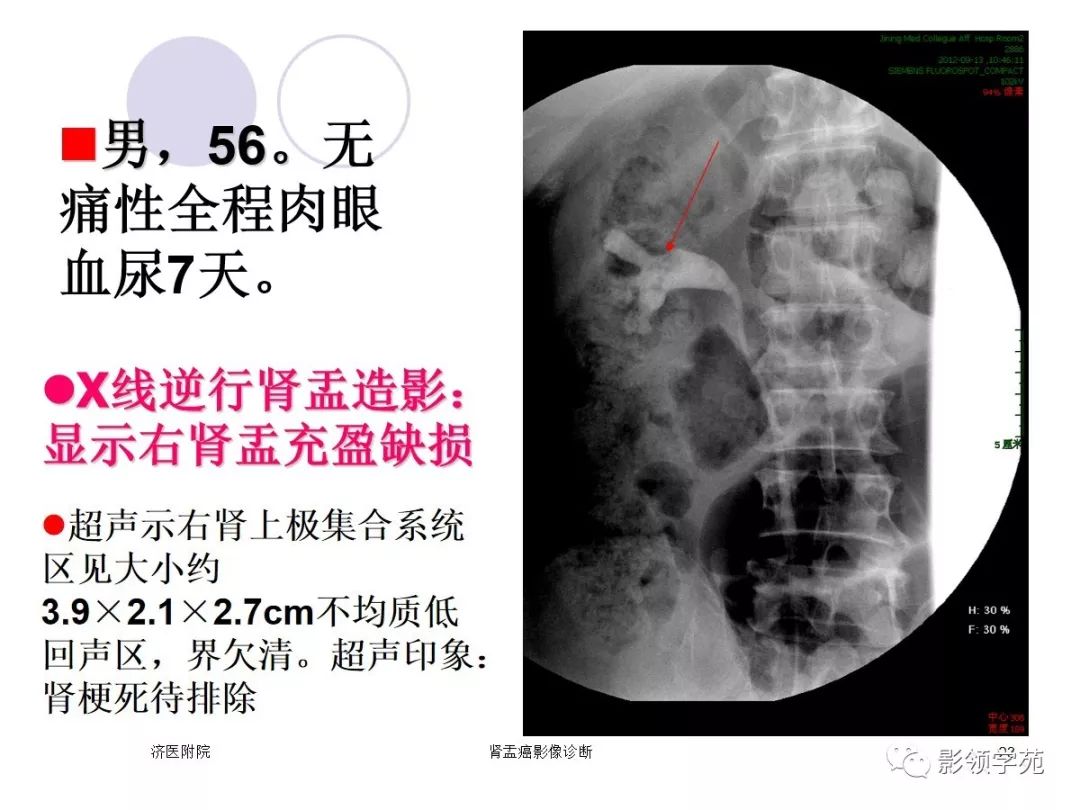 肾盂癌图片图片