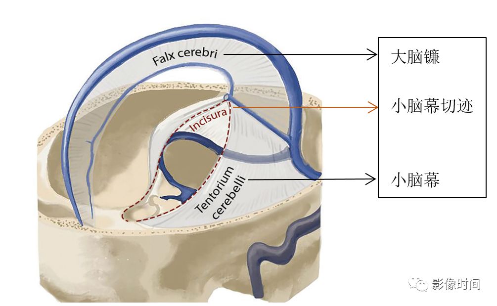 小脑幕切迹疝示意图图片