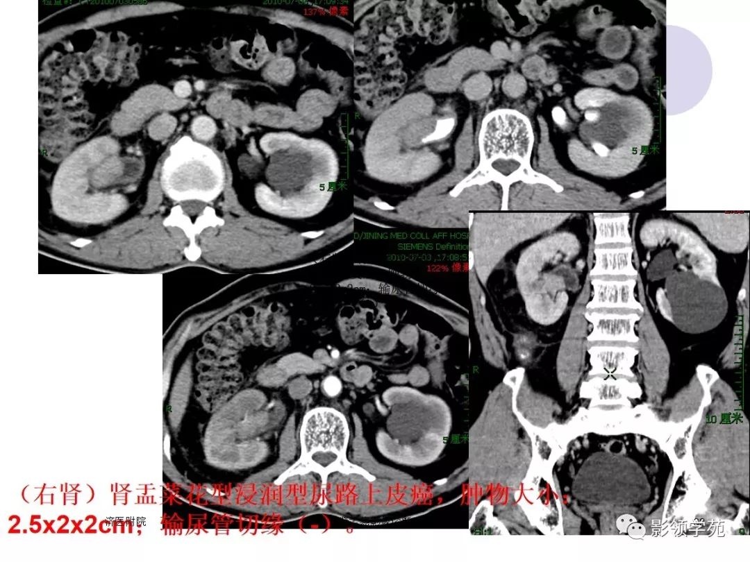 肾盂癌的影像诊断