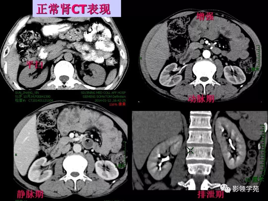 肾盂癌的影像诊断