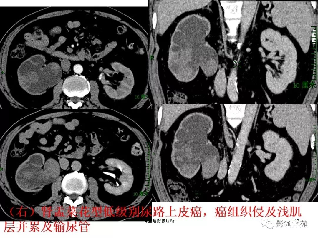 肾盂癌的影像诊断