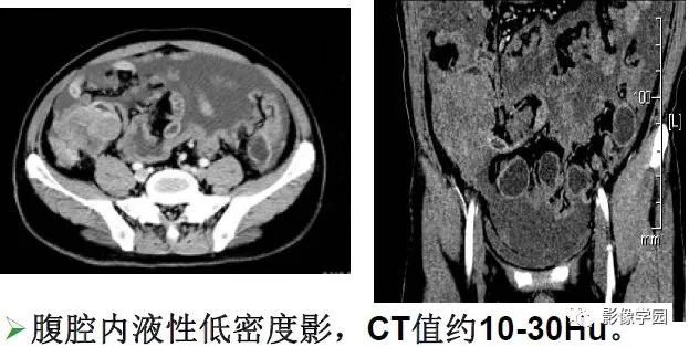 腹腔积液的ct表现图图片