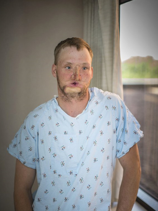 男子意外失去半边脸,被视为"怪物",10年后通过换脸手术获新生