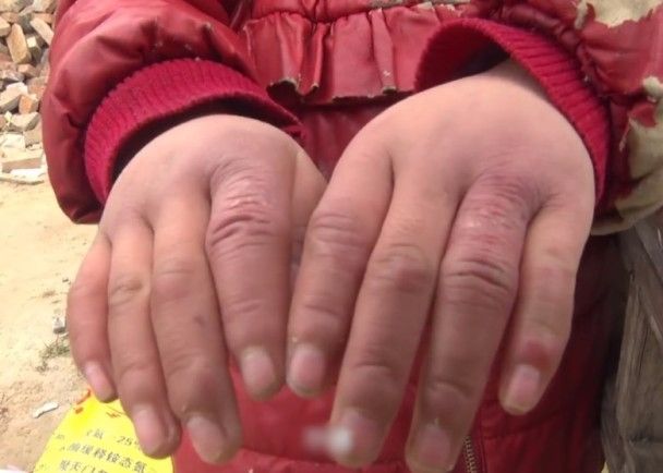 13岁的鲁某扫雪3个小时,全程没有戴手套,手指被严重冻伤,右手手指大