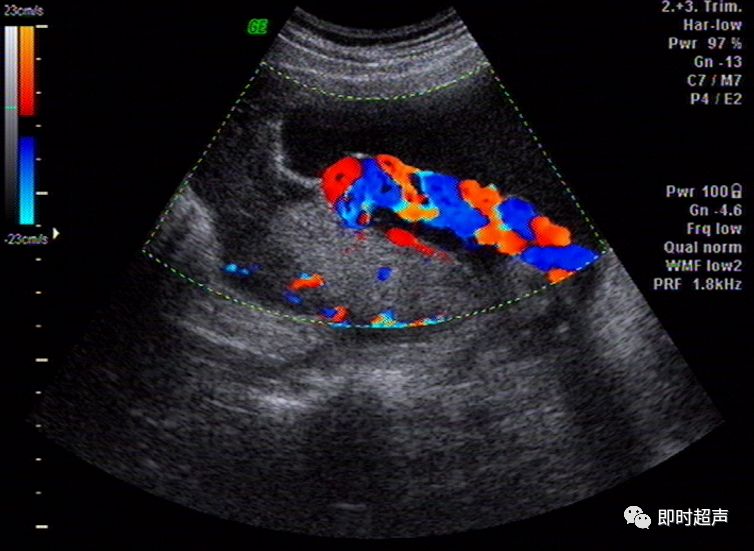 球拍状胎盘球拍状胎盘单脐动脉 显示胎盘与脐带的关系膈疝(胃泡)隔离