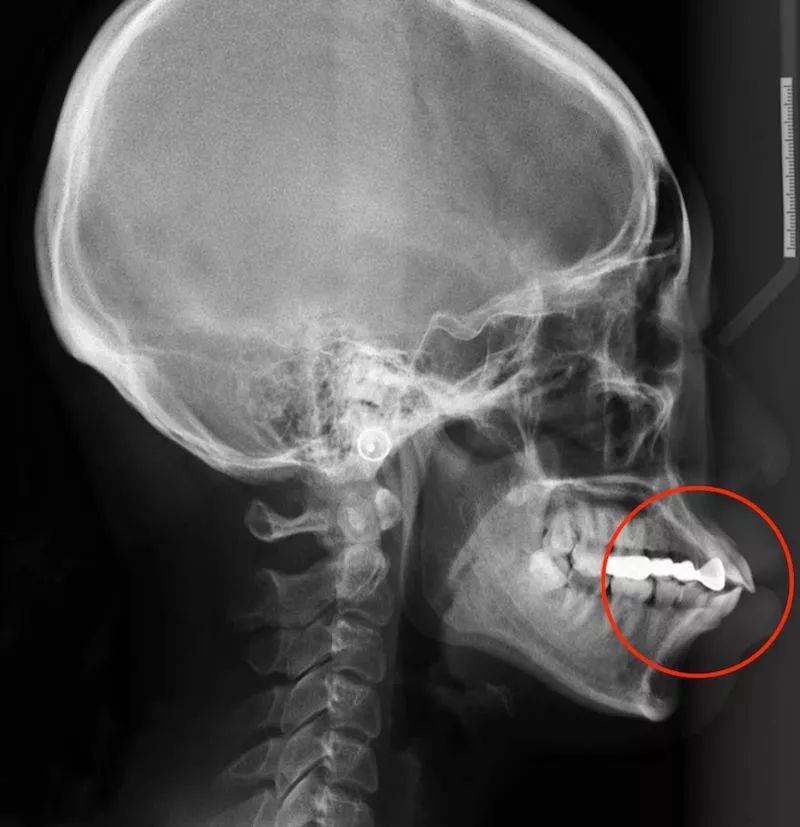 混合型的治疗方案,需要根据实际的牙齿情况以及头颅侧位片来定夺.