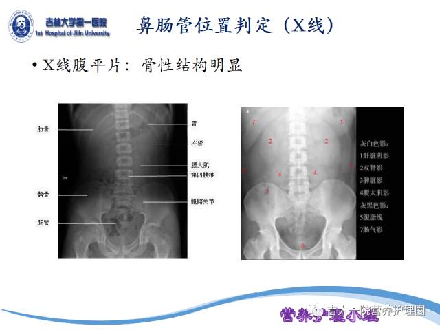 鼻空肠管X线图片