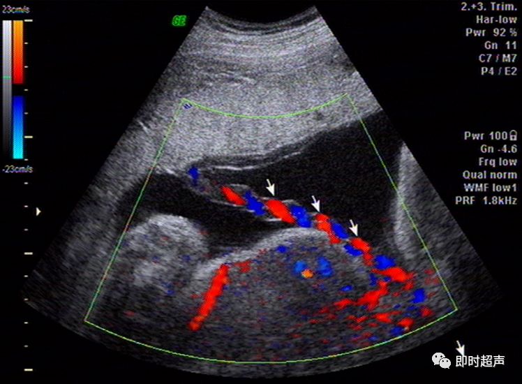 超详细图文胎儿中晚孕超声常用切面及胎儿常见异常畸形