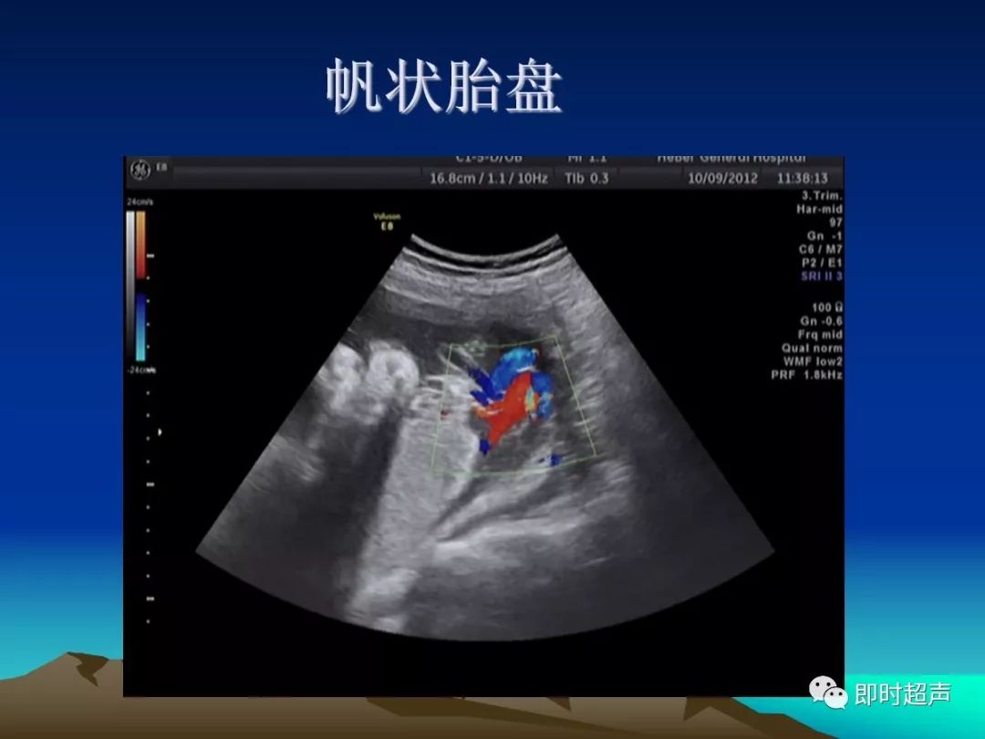 球拍状胎盘球拍状胎盘单脐动脉 显示胎盘与脐带的关系膈疝(胃泡)隔离