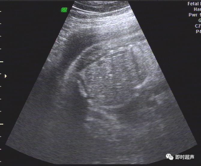 超详细图文胎儿中晚孕超声常用切面及胎儿常见异常畸形