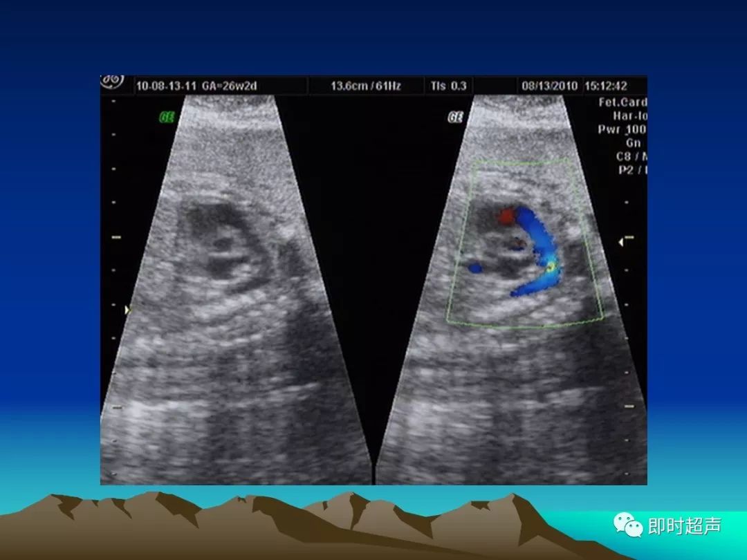 超詳細圖文胎兒中晚孕超聲常用切面及胎兒常見異常畸形