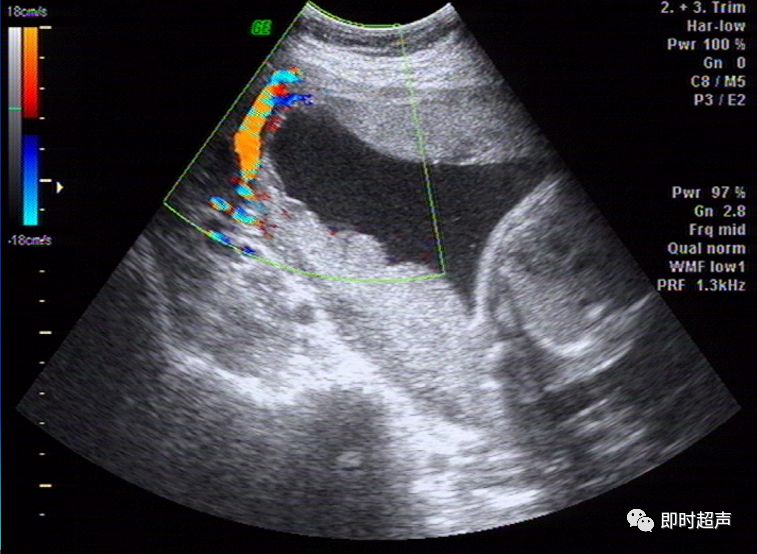 副胎盘胎盘囊肿胎盘植入副胎盘脐带囊肿脐带长24cm胎盘与脐带的连接