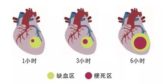 我院心血管内科成功抢救左主干病变导致急性心肌梗死患者