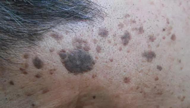 身上有黑痣,白斑,血痣竟意味着.赶紧来看看吧