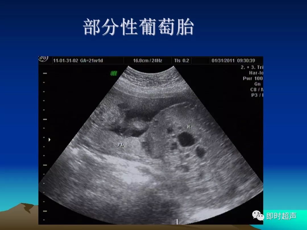 脐带囊肿脐带长24cm胎盘与脐带的连接关系球拍状胎盘球拍状胎盘单脐