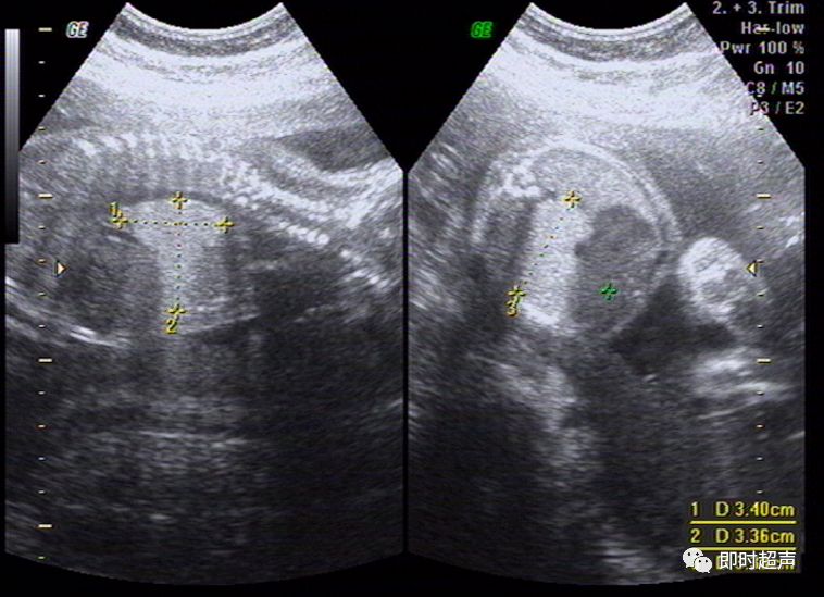 超詳細圖文胎兒中晚孕超聲常用切面及胎兒常見異常畸形