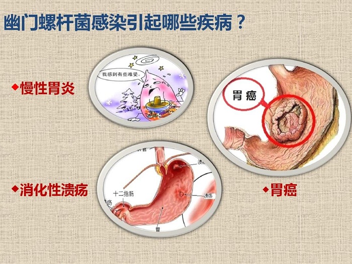 感染幽门杆菌,4种反应要小心!1片叶子丢水里,"扫清"幽门杆菌