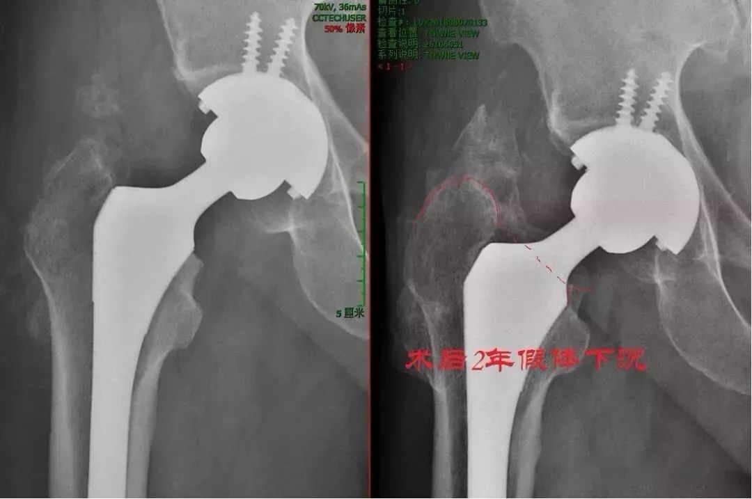 刘欢讲人工髋关节置换图片